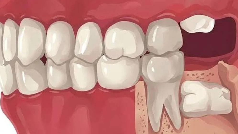 আক্কেল দাঁত কেন ওঠে, এত ব্যথা কেন হয়?